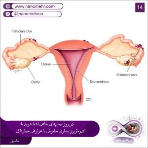 اندومتریوز بیماری خاموش با عوارض خطرناک